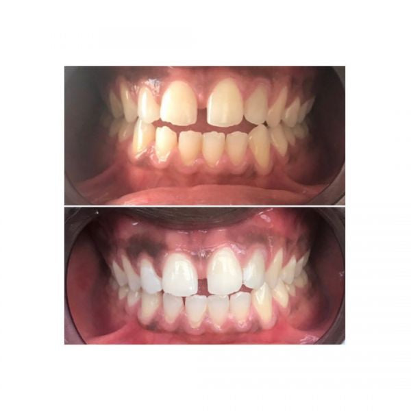 Duo blanchiment dentifrice et bain de bouche au charbon actif